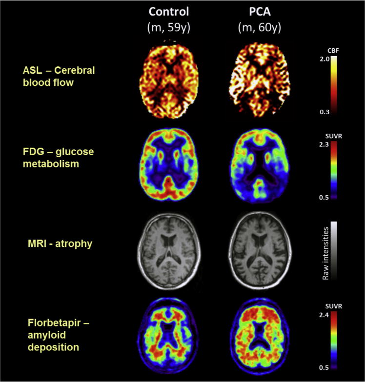Single-participant axial images for one control participant and one patient with PCA showing cerebral blood flow (ASL), glucose metabolism (FDG-PET), atrophy (structural magnetic resonance imaging), and amyloid deposition (florbetapir-PET). For clinical purposes, 18F-florbetapir images should be read on a gray scale. Abbreviations: ASL, arterial spin labeling; CBF, cerebral blood flow; FDG-PET, 18F-labeled fluorodeoxyglucose positron emission tomography; PCA, posterior cortical atrophy; SUVR, standard uptake value ratio. For tau deposition data see Ossenkoppele et al [2]. Adapted from Lehmann et al., 2016, Figure 1.