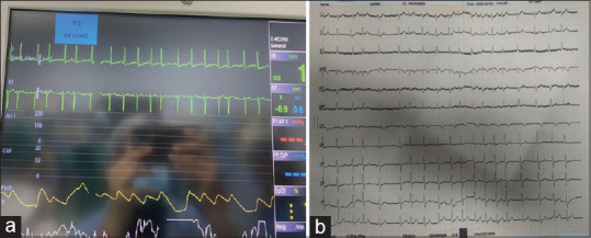 (a) Monitor showing ECG changes; (b) postoperative ECG showing atrial fibrillation