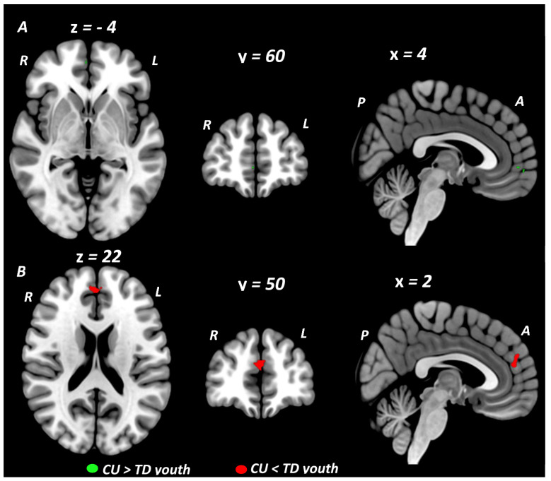 Meta-analysis Results Showing BOLD Signal Differences Between Cannabis Using and Typically Developing Youth during Executive Function/Cognitive Control (A) and Social Cognition/Emotion Processing (B). (A) Meta-analysis results for executive function/cognitive control studies. An increase in activation in CU youth compared to TD youth during executive control in the rostral medial prefrontal cortex (mPFC) (peak cluster of 5 voxels; MNI coordinates: x = 4, y = 60, z = −4) is shown in green. (B) Meta-analysis results for social cognition/emotion processing studies. A decrease in activation in CU versus TD youth during social cognition and emotion processing in the dorsal mPFC and dorsal anterior cingulate cortex (peak cluster of 64 voxels; MNI coordinates: x = 2, y = 50, z = 22) is shown in red. All results are thresholded at p < 0.005. Images visualized using MRIcroGL and presented on SDM template. Abbreviations: BOLD = blood-oxygen-level-dependent; CU = cannabis using; TD = typically developing; MNI = Montreal Neurologic Institute coordinates; mPFC = medial prefrontal cortex; R = right; L = left; A = anterior; P = posterior; CU = Cannabis Using; TD = typically developing.