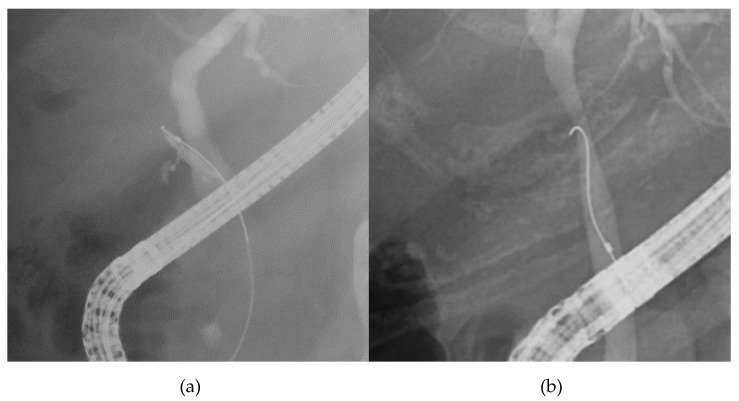 Cholangiography image of cranial branch and caudal branch; (a): cranial branch, (b): caudal branch.