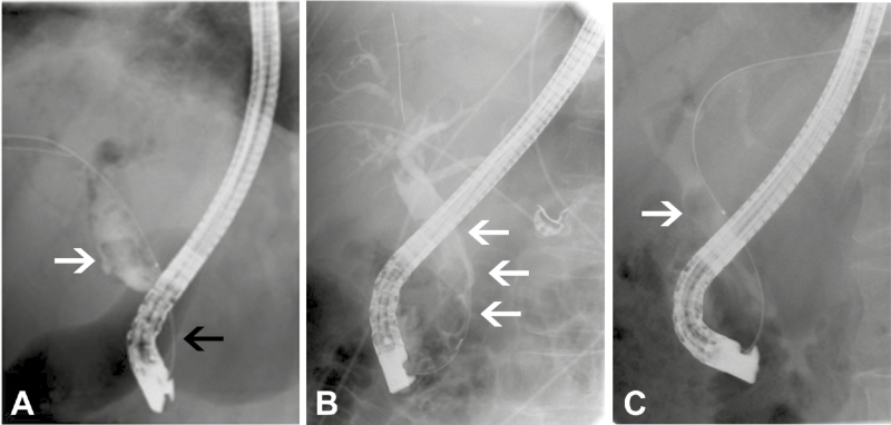 ‘Difficult’ common bile duct (CBD) stones. A, single, large, faceted stone (white arrow) proximal to a CBD stricture (black arrow). B, multiple, stacked stones (arrows). C, stone impacted in CBD (arrow).