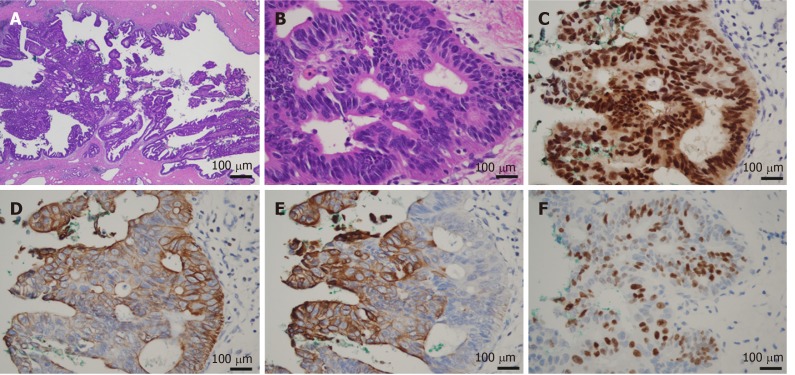 Microscopic ﬁndings of the bile duct tumor. A: The tumor showed the intraductal papillary proliferation of columnar cells with a high nuclear/cytoplasmic ratio; B: These neoplastic cells were entirely confined within the duct, and no invasion was identified (A: magnification × 20, B: magnification × 400); C-F: Immunohistological staining showed that the tumor cells were positive for CDX2, CK7, CK20, and Ki67.