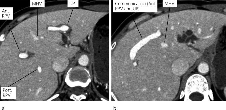 Enhanced CT images. Enhanced CT scan reveals a dilated IHBD in the left lobe and a communication between the right portal vein and umbilical portion (a, b). CT: computed tomography; IHBD: intrahepatic bile duct; MHV: middle hepatic vein; Ant. RPV: anterior right portal vein; Post. RPV: posterior right portal vein, UP: umbilical portion