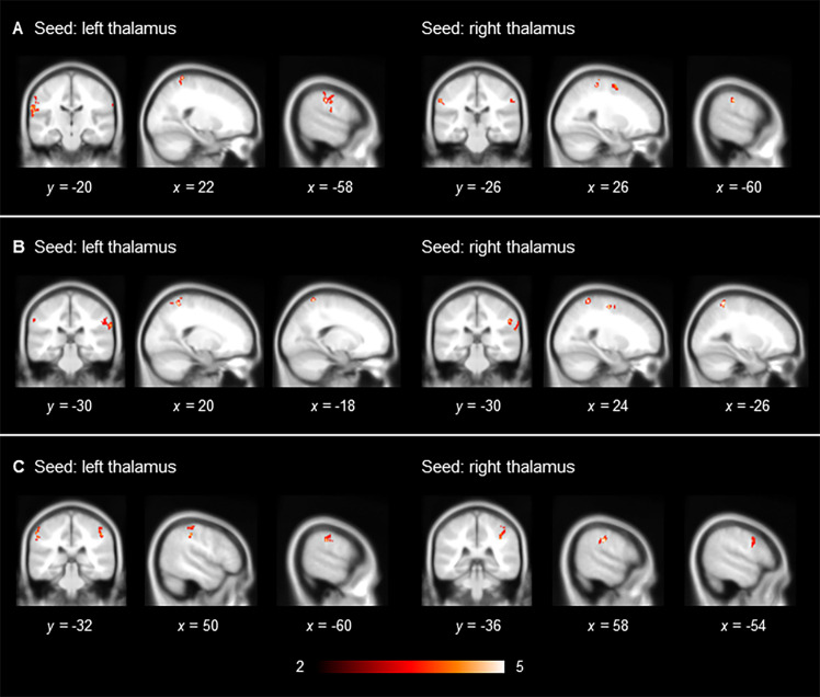 Significant increase in thalamic functional connectivity in adult cannabis non-users with a childhood diagnosis of ADHD compared with their counterparts who were cannabis users.(A) Scrubbing (+), global signal regression (+); (B) scrubbing (−), global signal regression (+), and (C) scrubbing (−), global signal regression (−). Results are displayed at a family-wise error-corrected cluster-defining threshold of p < 0.025.