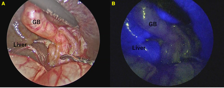 Fluorescence cholangiography in patients with biliary atresia. Only the liver appeared to fluoresce strongly. (A) Normal view. (B) Fluorescence cholangiography.