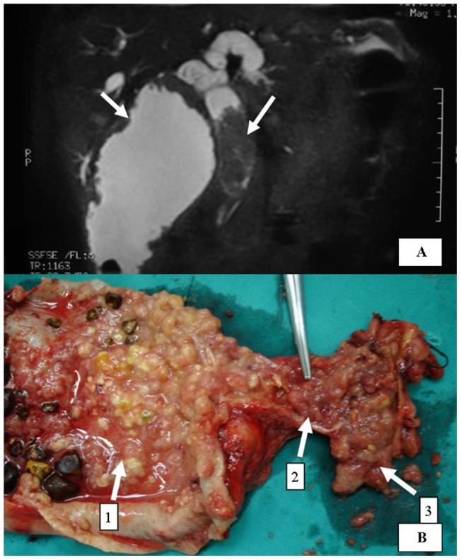 A jaundiced gallbladder carcinoma with tumor thrombus in common bile duct.(A: MRCP photography shows filling defect in CBD and gallbladder; B: In surgery specimen arrows 1–3 point at tumor tissues in gallbladder, cystic duct and CBD respectively.) We state that the subject of the photograph has given written informed consent by the patient to publication of the photograph.