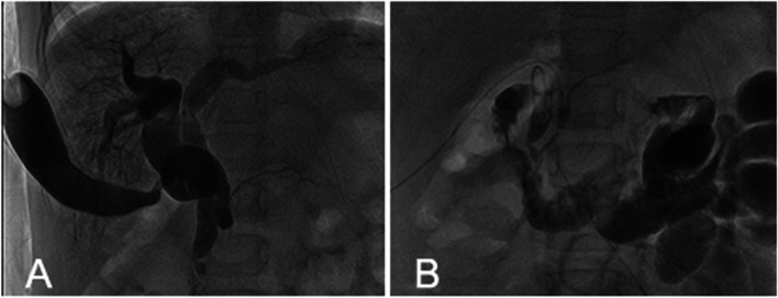 A IOC showed the dilated double duct and the gallbladder was connected to the duplicated bile duct. B IOC after operation showed that the morphology and drainage of common bile duct became normal, and large amounts of contrast medium entered into the duodenum and jejunum