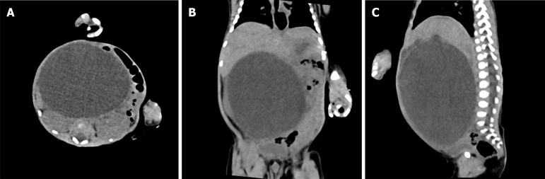 Preoperative computed tomography imaging of giant biliary dilation. A: Horizontal view; B: Coronal view; C: Sagittal view.