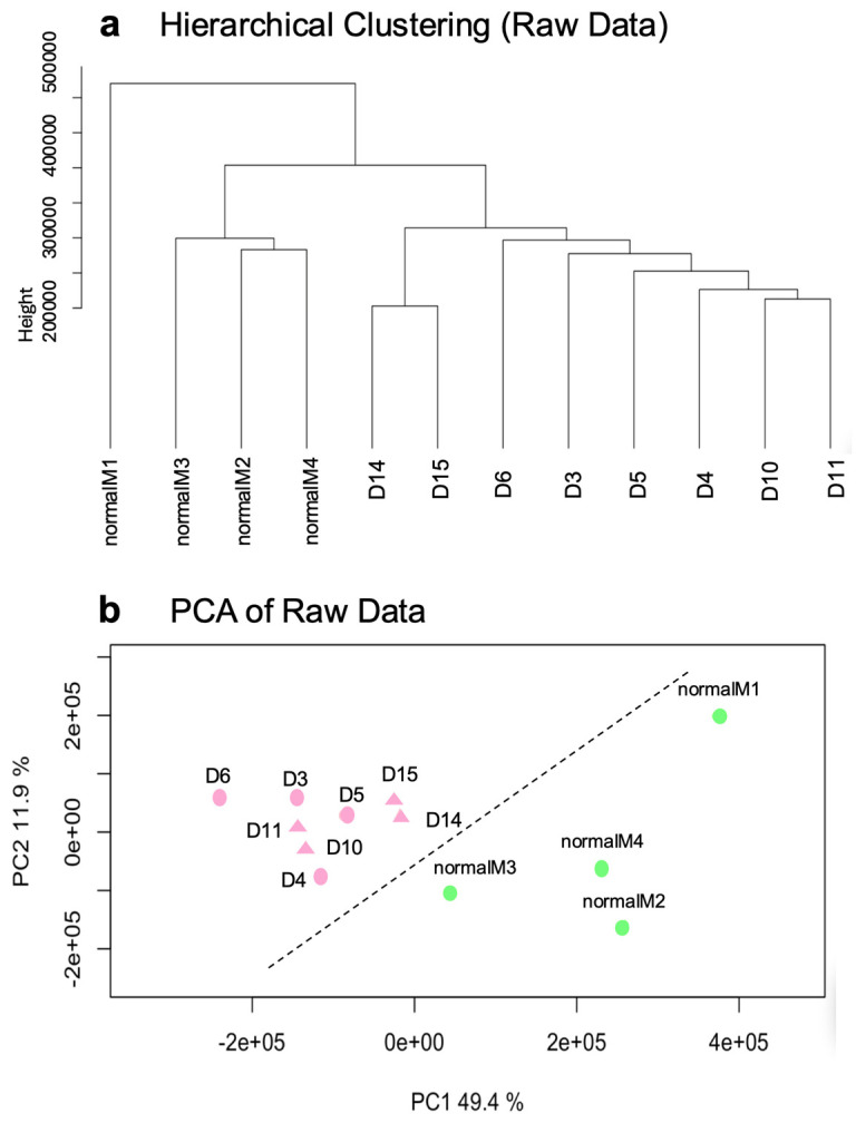 Exploratory analysis of raw microarray data. (a) Hierarchical clustering of unprocessed expression values showing two distinct sample groups corresponding to normal meninges and DT-G1 meningiomas. (b) Principal component analysis (PCA) of raw data. PC1 and PC2 together explain 61.3% of the variance and position meningioma samples and control meninges in clearly separate regions of the plot (figure panels generated using the dataset described in Supplementary Table S3).
