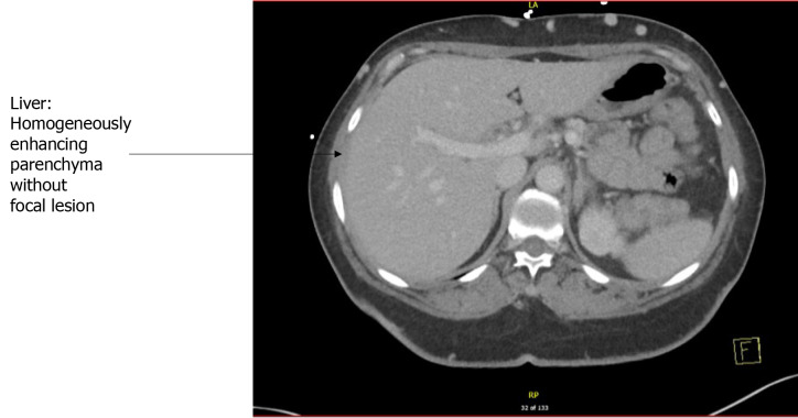 Computed tomography scan of abdomen.
