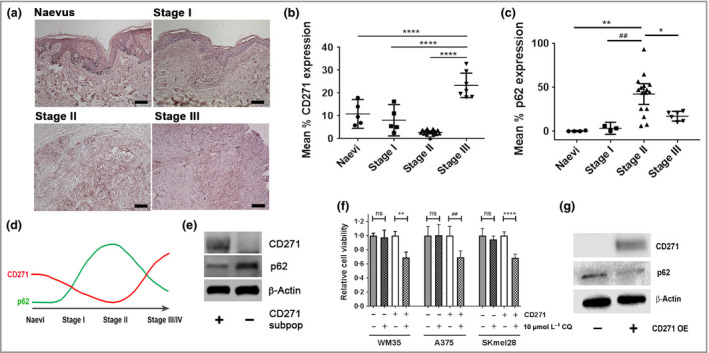 Expression and correlation of CD271 and the autophagy marker p62 in primary melanomas and metastatic melanoma cell lines. (a) Representative photomicrographs of immunohistochemical CD271 staining (pink) in a human benign naevus and American Joint Committee on Cancer (AJCC) stage I–III primary melanomas of increasing Breslow depth and spread (scale bars = 100 μm). Semi‐quantitative scoring of (b) CD271 and (c) p62 expression in naevi (n = 5) and AJCC stage I (n = 5), stage II (n = 15) and stage III (n = 7) primary melanomas. Each point is the mean CD271 or p62 expression of 10 images taken of each naevus or primary melanoma ± 95% confidence interval [CI; one‐way anova with Tukey's post‐hoc correction (*P = 0·027, **P = 0·001, ## P = 0·007, ****P < 0·001)]. (d) Schematic of observed pattern of CD271 expression (red line) during melanoma progression vs. previously reported biphasic expression of p62 (green line). (e) Representative Western blot analysis of CD271 (75 KDa), p62 (65 KDa) and β‐actin (42 KDa) expression in subpopulations of the WM35 metastatic melanoma cell line isolated using CD271 antibody‐tagged microbeads and magnetic separation columns. (f) Relative viability, as measured by 3‐(4,5,dimethythiazol‐2‐y)‐5‐(3‐carboxymethoxy‐phenyl)‐2‐(4‐sulfophenyl)‐2H‐tetrazolium, inner salt (MTS) metabolism, of isolated CD271+ and CD271– subpopulations from WM35, A375 and SKmel28 melanoma cell lines following 24‐h treatment in the presence or absence of 10 μmol L−1 chloroquine (CQ) [n = 18 replicates from three independent experiments; mean ± 95% CI, one‐way anova with Tukey's post‐hoc correction (**P = 0·003, ## P = 0·001, ****P < 0·001)]. ns, nonsignficant. (g) Representative Western blot analysis of CD271 (75 KDa), p62 (65 KDa) and β‐actin (42 KDa) expression in WM35 cells before and after lentiviral‐mediated overexpression of CD271 (CD271 OE).