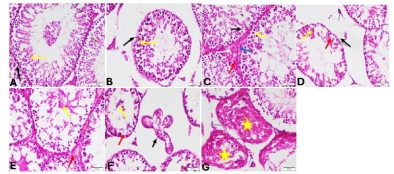Testis sections stained by H&E for sedentary rats. (A): Control group showing normal histological structure of testis intact seminiferous tubule (black arrow), normal germinal layers (yellow arrow) and normal Leydig cell (blue arrow) (B and C): Stanz group (B) showing necrosis of germinal layers (yellow arrow) and undulating basement membrane of seminiferous tubules (balack arrow) as well as degeneration of leyding cell (blue arrow). (C) showing degeneration of germinal cells (yellow arrow), congested blood vessels (red arrow) and edema (red star). (D and E) Cann group showing necrosis of germinal layers (yellow arrow) and undulating basement membrane of seminiferous tubules (black arrow) as well as degeneration of leyding cell (blue arrow) (E): degeneration of germinal cells (yellow arrow), congested blood vessels (red arrow). (F and G) combined group showing evacuation of all seminiferous tubules from germinal epithelium (yellow star), undulating basement membrane (black arrow), atrophy of Leydig cells (blue arrow) and wide interstitial space (red arrow) (G): degeneration of all seminiferous tubules and all germinal layers (yellow stars)