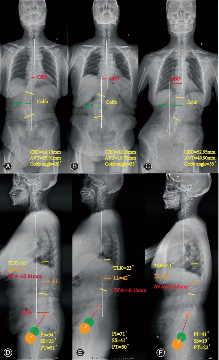 Radiographs showing three sub‐types: Type A (A, D) shows CBD 16.19 mm, AVT 25.91 mm, Cobb Angle 28°, TLK 10°, LL 21°, SVA 65.81 mm, SS 23°, PI 54°. Type B (B, E) shows CBD 31.29 mm, AVT 19.70 mm, Cobb Angle 33°, TLK 23°, LL 42°, SVA −8.13 mm, SS 41°, PI 71°; Type C (C, F) showed CBD 52.95 mm, AVT 49.90 mm, Cobb Angle 33°, TLK 11°, LL 22°, SVA 32.42 mm, SS 19°, PI 41°.