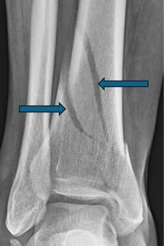 X‐ray showing closed distal tibia fracture.