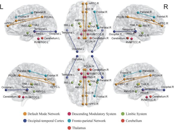 The main findings of acupuncture for migraine by neuroimaging techniques. The high frequent reported areas that have been affected by acupuncture for migraine in the included studies were noted with balls in different colors. Different colors of the nodes and edges represent different brain regions and networks. ACC, anterior cingulate cortex; AMYG, amygdala; INS, insula; MFG, middle frontal gyrus; MTG, medial temporal gyrus; PAG, periaqueductal gray; PCUN, precuneus; mPFC, medial prefrontal cortex; RVM, rostral ventromedial medulla; TCC, trigeminal cervical complex; THA, thalamus.