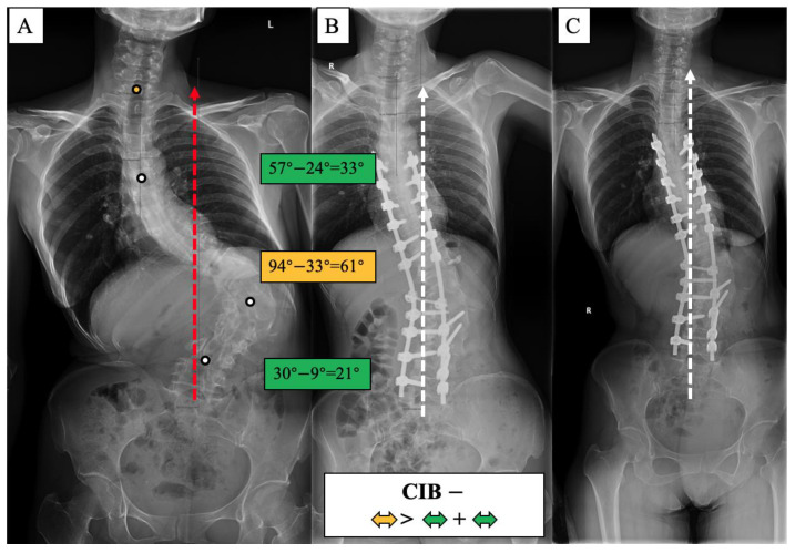 CIB− case, 27-year-old female AdIS patient ((A): preoperation, (B): postoperation, and (C): 2.5-year follow-up). The main thoracolumbar curve was corrected from 94° to 33° (61° correction). The thoracic curve was corrected from 57° to 24° (33° correction), and the lumbar-sacral curve was corrected from 30° to 9° (21° correction). The correction rate of the main curve was greater than the compensatory curves. The coronal plane balance was improved after surgery, and further improvement could be observed at the final follow-up.