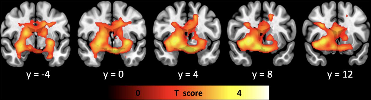 Full volume analysis showing the positive association of family income with brain glucose metabolism