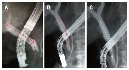 Common bile duct angulation calculation methods. Accumulative score (A and B): The axis (red line) runs through the center of the CBD. Each internal angle was measured at the angulation of the proximal (A) and distal (B) bile duct level respectively. The values of both angles were added (A + B). If either part of the CBD was not angulated a set score of 180 was used[13]. Minimal angle score (C): Angulation (A) was measured as the sharpest angle along the CBD from 1 cm below the bifurcation to 1 cm above the papilla[14]. CBD: Common bile duct.