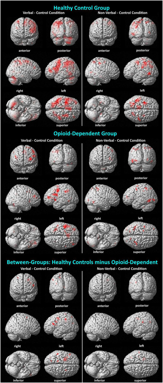 Visualization of BOLD activation associated with verbal and non-verbal WM. Surface renderings of BOLD activations display activations listed in Table 4, as well as activations that did not pass a cluster size threshold of p < 0.05. Thus, there are more activations shown here than in Table 4. Minimum cluster size = 10 voxels; all activations p < 0.001. In all comparisons, the activations are shown for the WM condition (verbal or non-verbal) minus the control condition. In the between-groups comparison, activations reflect a double subtraction [HC (WM – control conditions) – OP (WM – control conditions)].