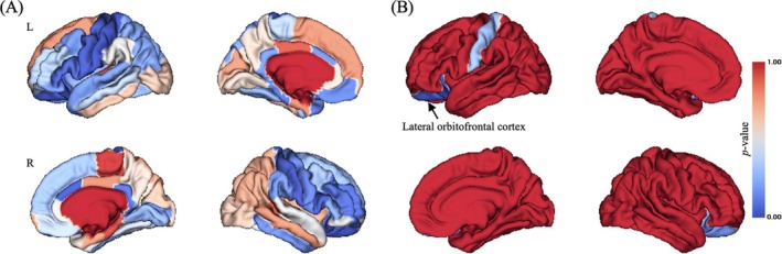 Brain pattern of group main effect on CT. (A) Uncorrected p value distribution for group main effect on CT; (B) Bonferroni correction of p value distribution for group main effect on CT. L, left; R, right. The colour bar represented p value of group main effect on CT.