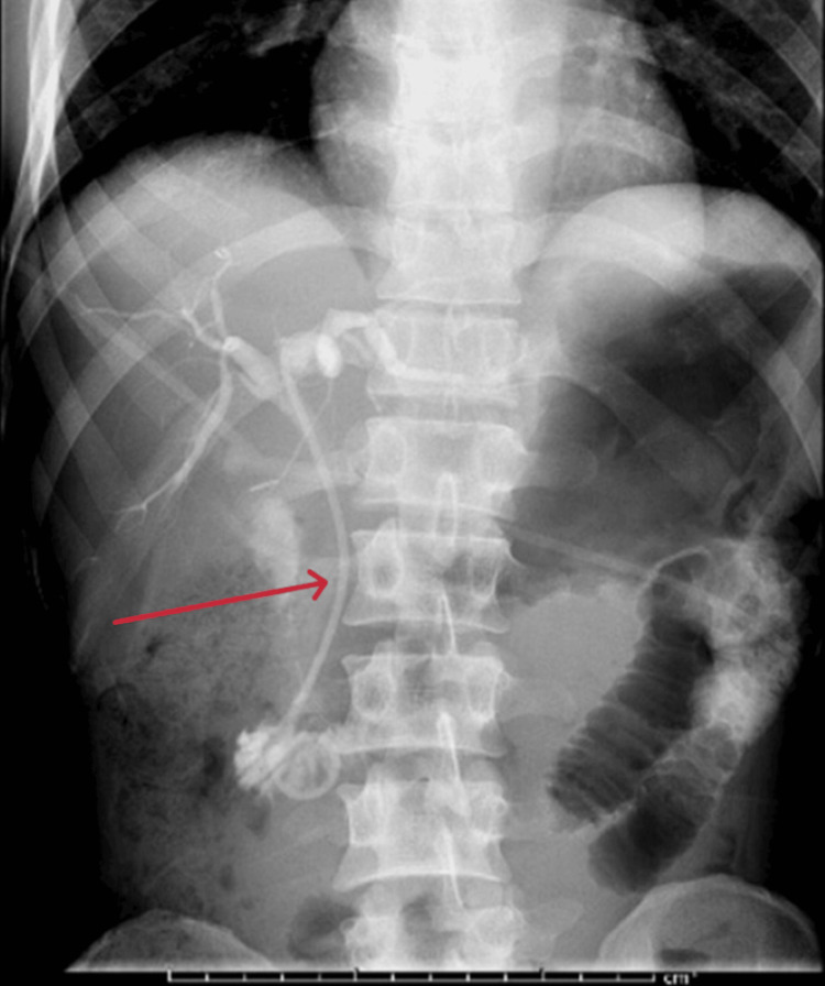 ERCP demonstrating biliary stent placementEndoscopic retrograde cholangiopancreatography (ERCP) shows the inserted plastic stent (red arrow) within the common bile duct, resulting in a significant reduction of the obstructive appearance of the hepatic biliary ducts.