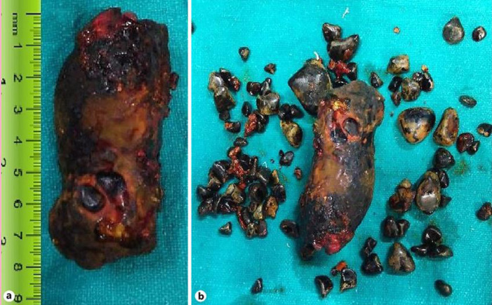 Calculi retrieved from choledochal cysts. a 8.0 × 4.5 × 4.0 cm sized giant calculus of a extrahepatic choledochal cyst. b Giant calculus with around 100 small calculi of extra- and intrahepatic choledochal cysts.