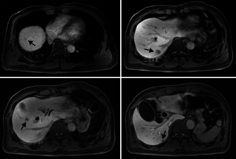 T1 magnetic resonance imaging for preoperative evaluation shows multifocal low signal intensity nodular lesions in the right lobe (arrows).