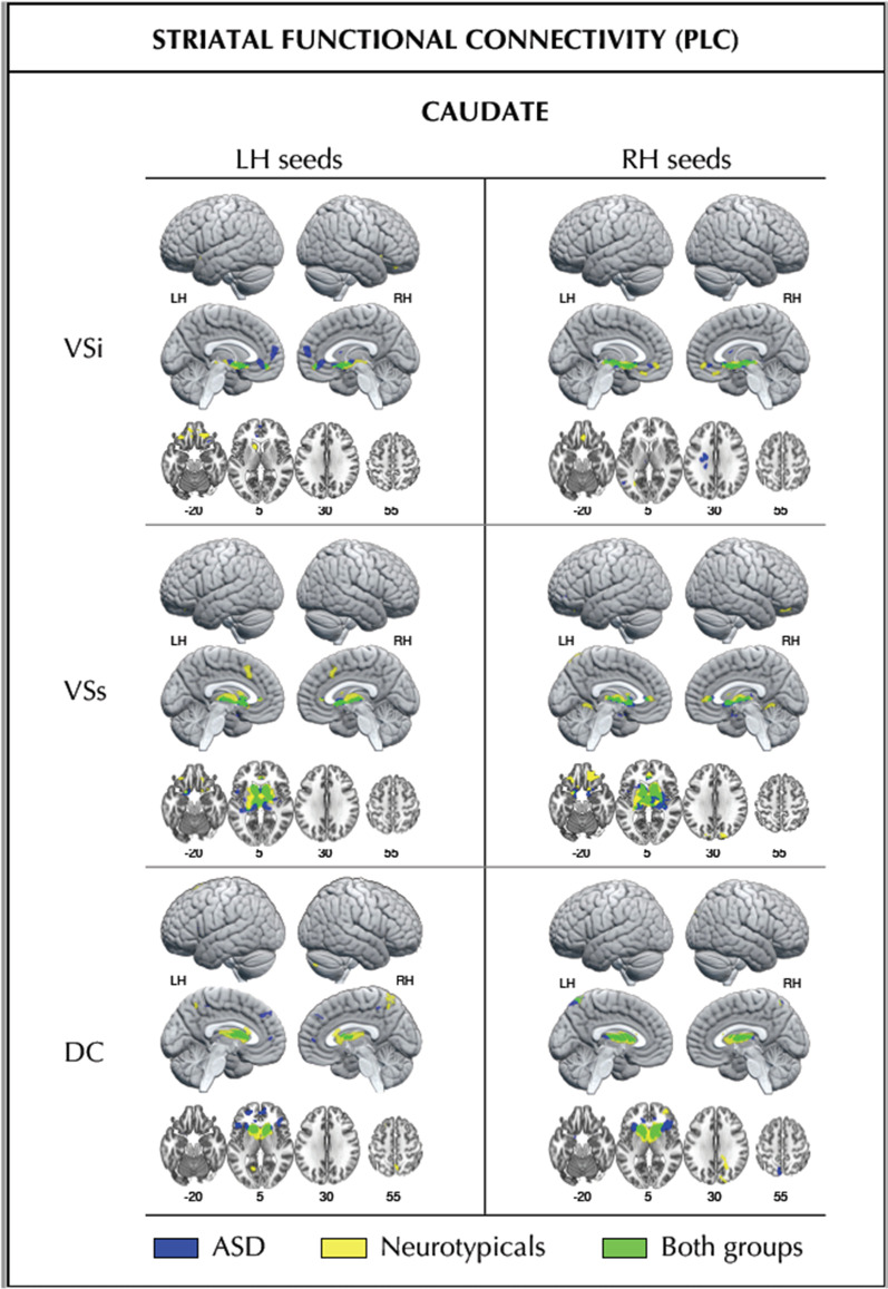 Baseline striatal (caudate) functional connectivity within each participant group. Striatal (caudate) functional connectivity at placebo in the ASD group (blue), the neurotypicals (yellow), and the overlap of both groups (green). Numbers below slices indicate Montreal Neurological Institute (MNI) z-coordinates. DC dorsal caudate, LH left hemisphere, RH right hemisphere, VSi inferior ventral striatum, VSs superior ventral striatum