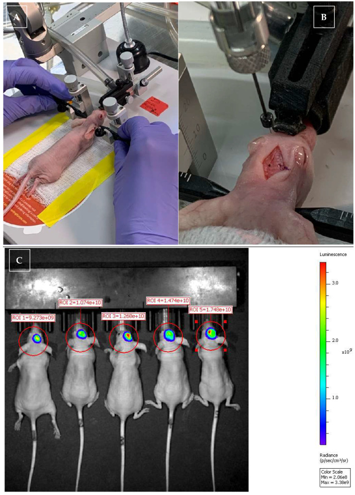 Pictures of glioma implantation and IVIS imaging for monitoring glioma size, and gross pictures of the J3TBG glioma that was implanted and growing in the mice brain and subcutaneous area. Picture (A,B): During in vivo xenogeneic orthotopic glioma transplantation. Mice were mounted onto a stereotactic immobilization system (A), and a craniotomy was performed—the marker on the midline is bregma (B). IVIS imaging was collected twice per week to monitor glioma during the study period (C). Picture of a mouse after implanted tumor growth and before euthanasia due to tumor size (D). Pictures of necropsy: skin incision (E); brain extracted with a dorsal-to-ventral view, with the cranial aspect of the brain located at the top of the picture (F); and brain extracted with a dorsal-to-ventral view, with the cranial aspect of the brain located at the bottom of the picture (G). A grown tumor is visible in the frontoparietal lobe (F,G).