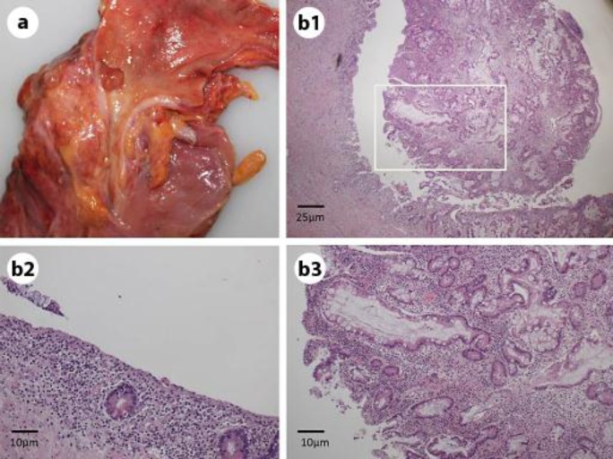 a A 6-mm polyp in the middle portion of the CBD. b1 Normal ductal structure and multiple plasmacyte migration were identified in the polyp (hematoxylin and eosin staining). b2 No atypical cells were found in the biliary mucosa around the polyp. b3 Enlargement of the inset in b1. b1–b3 Hematoxylin and eosin staining.