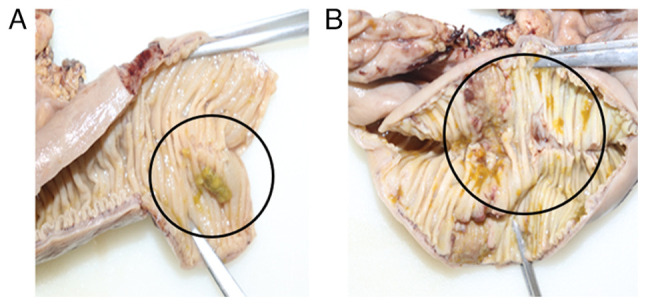 Macroscopic images of the resected intestinal segment. (A) A segment of the resected small intestine with focal mucosal ulceration and yellowish discoloration suggestive of caseating necrosis (black circle) is presented. The mucosal folds appear thickened, with evident loss of normal architecture in the affected area, indicative of localized granulomatous inflammation. (B) A more extensive segment is observed with diffuse mucosal thickening and multiple areas of yellowish exudate, consistent with widespread caseation (black circle). The transmural involvement and rigidity of the intestinal wall suggest chronic inflammation with possible fibrosis.