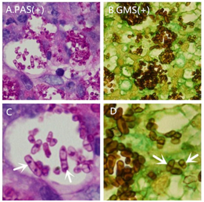 T. marneffei’s specific sausage-like cells and cross-walls can be observed by PAS staining and GMS staining.