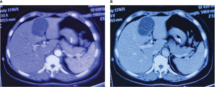 Typical images of contrast-enhanced computed tomography of the liver lesions. (A) The arterial phase image of the liver lesions. (B) The venous phase image of the liver lesions.