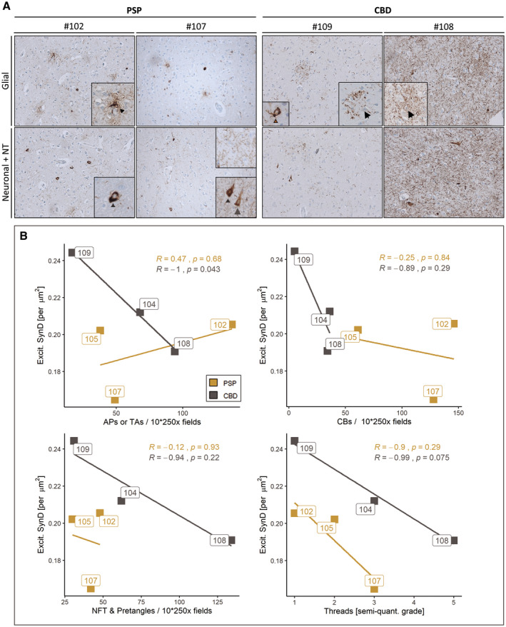 Synapse densities correlate with the occurrence of APs but not TAs in the frontal cortex. (a) Diverse AT8 inclusion pathology in fCtx of investigated PSP and CBD cases visualized by immunohistochemistry using the AT8 antibody. Representative light microscopy images depicting the extent of AT8+ cell type‐assigned neuropathology in those two PSP cases (left panel) and those two CBD cases (right panel) with the highest synapse counts (left column of each panel) and lowest synapse counts (right column of each panel). Insets depict particular AT8 traits of affected brain cell types. The upper row shows glial pathology with TA (arrowhead), APs (arrow), and a CB (brown arrow); the lower row depicts neuronal pathology including pretangles (grey arrowhead), NFTs (grey arrow), together with NT of varying degrees. (b) In the fCtx the density of synapses correlates with neuropathological traits present in CBD (APs, trending with NT/threads), but not with the assessed traits seen in PSP (TAs, NFT, CB, NT/threads). Correlation scatter plots for excitatory synapse density (“Excit. SynD,” synapses per µm2 area) in the fCtx facetted by each of the assessed neuropathological traits: TAs and APs (upper left), CBs (upper right), NFTs and pretangles (lower left) as well as NTs (lower right). Color code indicates disease entity. Boxed labels show single case identifiers. Statistical results are expressed as Pearson’s R and respective decimal p values (see also Table 2). AP, astrocytic plaque; TA, tufted astrocyte