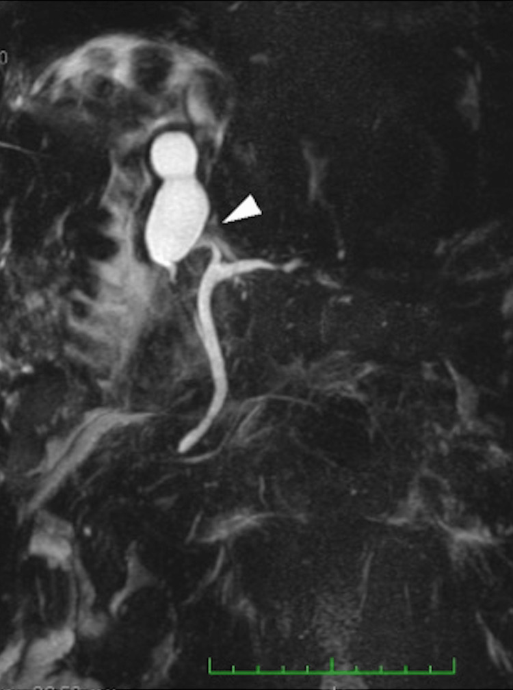 Case 2: Magnetic resonance cholangiopancreatography (MRCP).MRCP revealed atrophy of the right hepatic lobe, with the gallbladder situated along the right intrahepatic bile duct, consistent with a suprahepatic gallbladder (arrowhead).