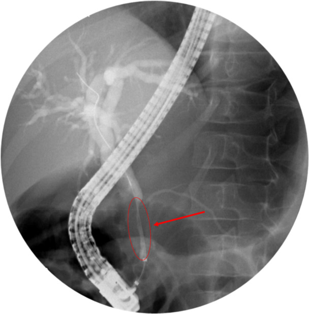 Initial cholangiogram during ERCP performed 24 days after injury. Cholangiogram demonstrating intrapancreatic stricture in the lower half of the CBD and prestenotic dilatation of the biliary tree. Arrow delineating narrow segment. CBD, common bile duct; ERCP, endoscopic retrograde cholangiopancreatography.