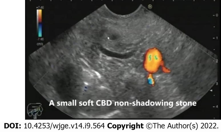 A small soft non-shadowing common bile duct stone as seen from the bulb of the duodenum. CBD: Common bile duct.