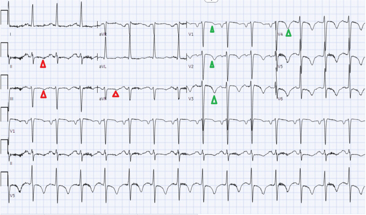 Electrocardiogram #2The findings show a normal sinus rhythm, left atrial enlargement, left anterior fascicular block, LVH (R in aVL, Cornell product), and prolonged QT (583 ms). When compared with EKG #1, inverted T waves have replaced nonspecific T wave abnormality in inferior leads (red arrowheads). T wave inversion is now evident in the anterior leads (green arrowheads)LVH: left ventricular hypertrophy
