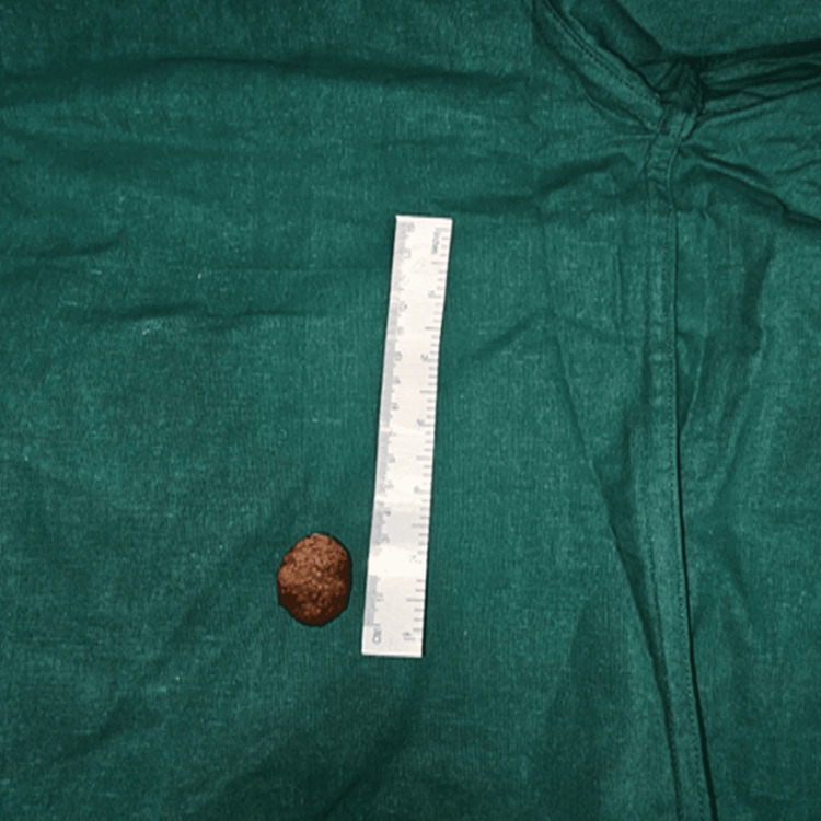 Gross specimen: large gallstone post cholecystectomy