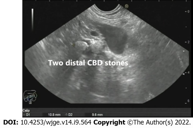 Two distal common bile duct stones as seen from the gastric body. CBD: Common bile duct.