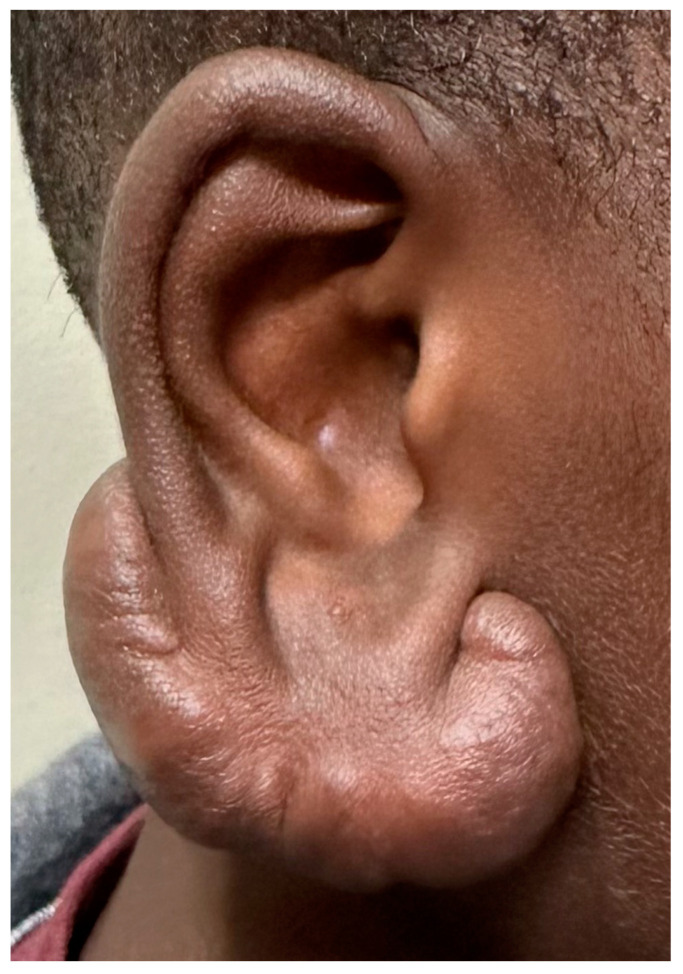 A large auricular keloid. It is firm, often with some continued enlargement and itching, and occasionally with increased warmth. In light of the Correia-Sá study, could this represent a deficiency in local arachidonoylethanolamine levels?