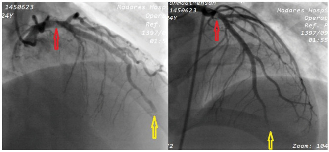 Coronary angiographic study showing, a filling defect (top arrow) in the proximal left anterior descending artery, suggestive of a thrombus and total thrombotic occlusion (bottom arrow) of the mid LAD with no distal flow