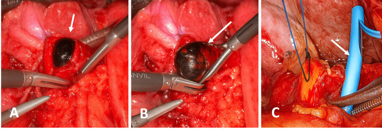 Laparoscopic common bile duct exploration.(A) Intraoperative view showing a gallstone lodged in the common bile duct.(B) Extraction of a single bile duct stone measuring 20 × 15 mm.(C) Retrieved biliary endoprosthesis following stone removal.