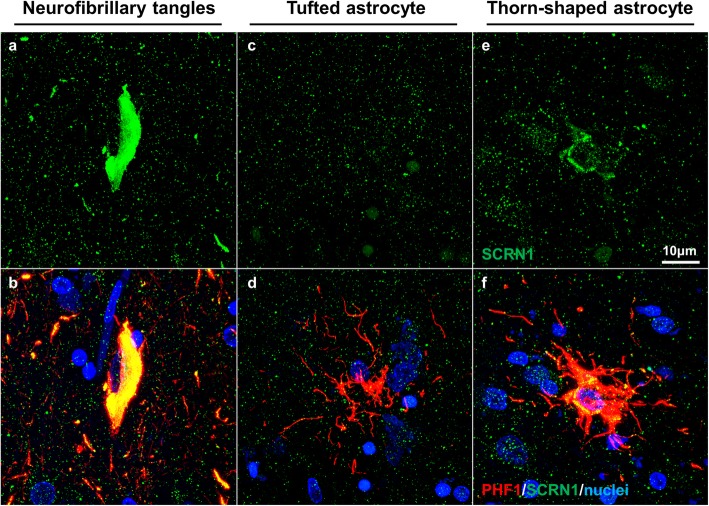 SCRN1 had limited immunoreactivity in ARTAG-associated thorn-shaped astrocytes in a mixed pathology case. a, b SCRN1 showed prominent accumulation in AD-associated NFTs. c, d Absence of SCRN1 in PSP-associated tufted astrocyte. e, f Minimal accumulation of SCRN1 around the nucleus in a thorn-shaped astrocyte
