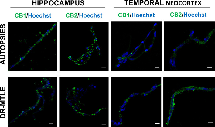 Immunofluorescence staining of CB1 and CB2 receptor proteins in microvessels isolated from the hippocampus and temporal neocortex of non-epileptic autopsies and patients with DR-MTLE. Cell nuclei were stained with Hoechst (in blue). In the group of patients with DR-MTLE, a low staining of CB1 and CB2 receptors can be observed in the hippocampus, whereas both receptors are highly expressed in the temporal neocortex. All scale bars are 20 μm.