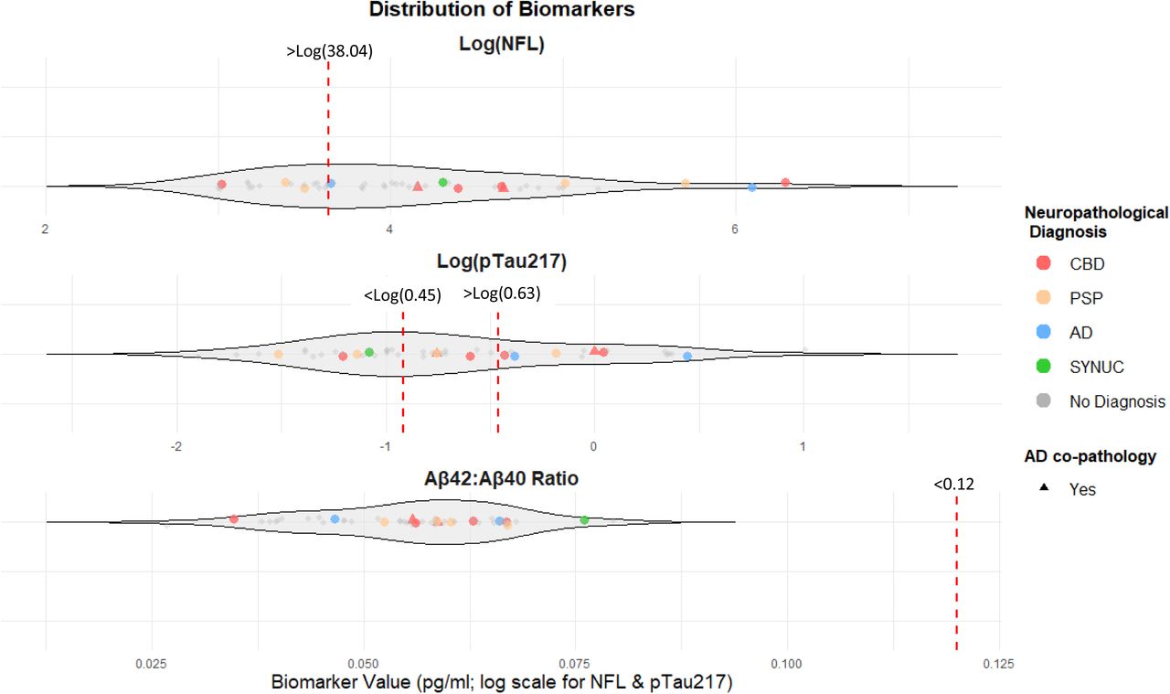 Plasma biomarker distributions.Violin plots show plasma NFL, pTau217, and Aβ42:Aβ40 ratio values (pg/mL). NFL and pTau217 are displayed on a logarithmic scale. Cases with neuropathological confirmation are colour-coded by diagnosis; those without post-mortem data are shown in grey. Individuals with a non-AD primary pathology and secondary AD co-pathology are marked with triangles. Published cut-offs for AD positivity are indicated by dotted lines (NFL > 38.04; pTau217 > 0.63 or < 0.45; Aβ42:Aβ40 < 0.12).