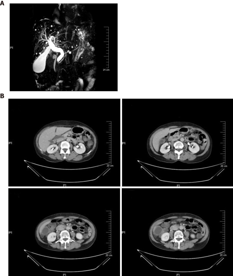 Magnetic resonance cholangiopancreatography and computed tomography images from our case. A: Magnetic resonance cholangiopancreatography image showing proximal bile duct dilatation but ambiguous findings for evaluation of the distal common bile duct; B: Computed tomography images showing diffused dilatation of the extra-hepatic bile duct and significantly enhanced bile duct wall.