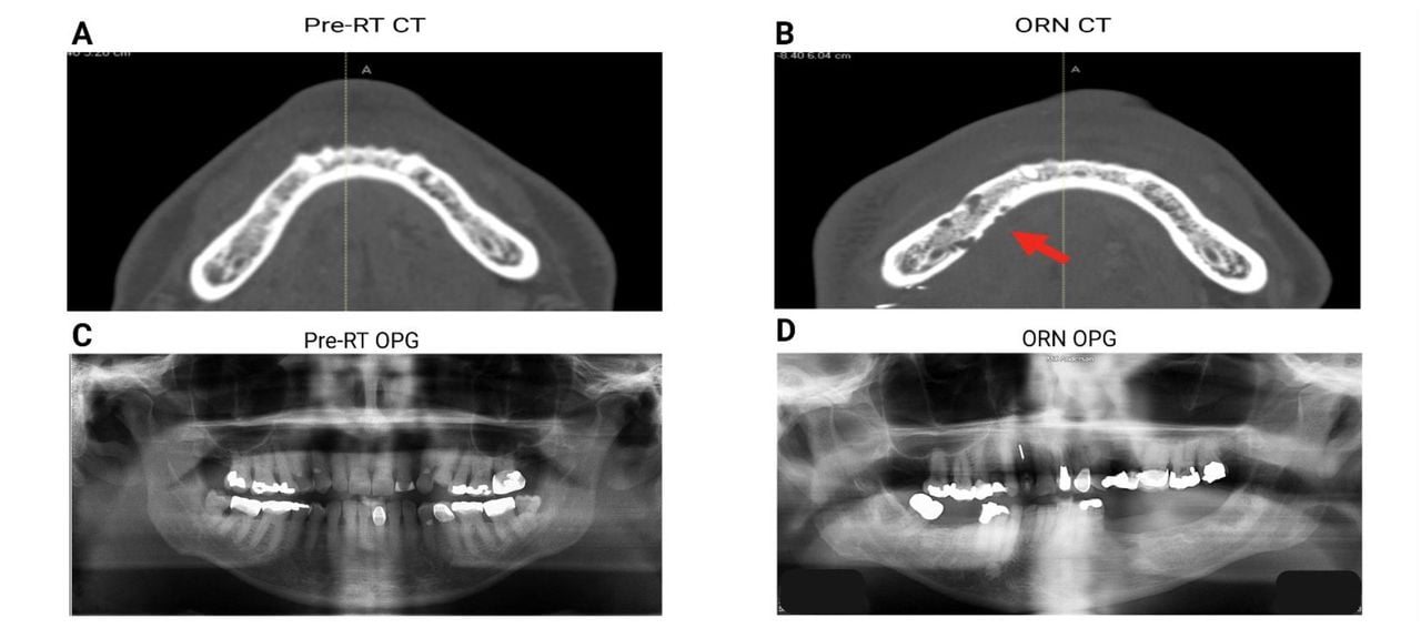 Examples of pre- and post-RT imaging modalities. Panels A and C show axial computerized tomography (CT) and orthopantomograms (OPG) scans of the mandible pre-RT, respectively. Panels B and D display corresponding post-RT images, in this case for a patient who developed ORN. These images represent the dataset provided to survey participants for the ORNJ diagnosis and severity classification assessments.