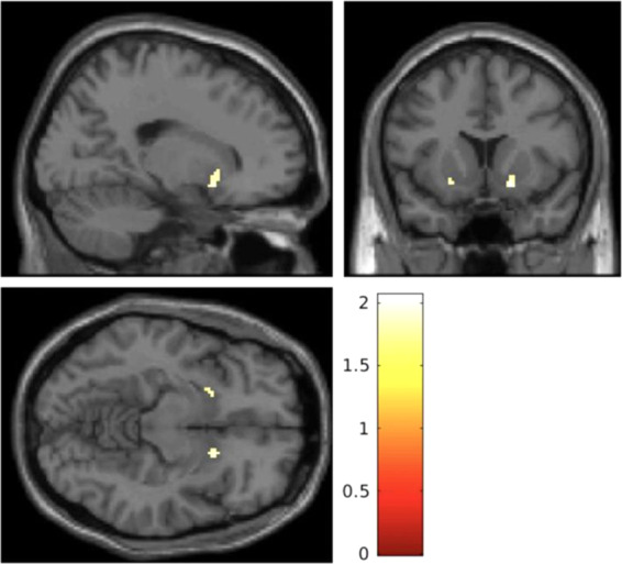 Statistical parametric maps showing that cannabinoid 1 receptor availability, as determined by the distribution volume of [11C] MePPEP, is significantly lower in the striatum in patients relative to controls.Results are show using a height threshold p < 0.05 for visualization purposes. The colour bar shows the t statistic.