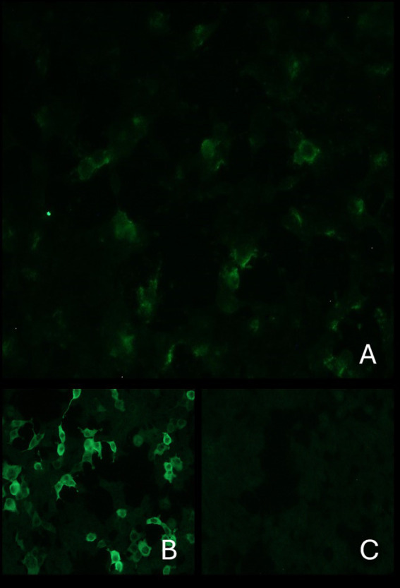 Indirect immunofluorescence: The top image shows the presence of anti-GAD antibodies in the serum of the current case (A). Images below: on the left positive control (B) and on the right negative control (C). Antibodies directed against GAD react with transfected cells of the substrate. These cause a fluorescence pattern of the cytoplasm. The cell nuclei are only faintly stained.
